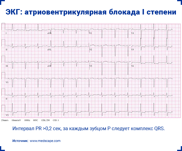 ЭКГ атриовентрикулярная блокада I степени